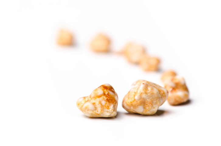 gallstones