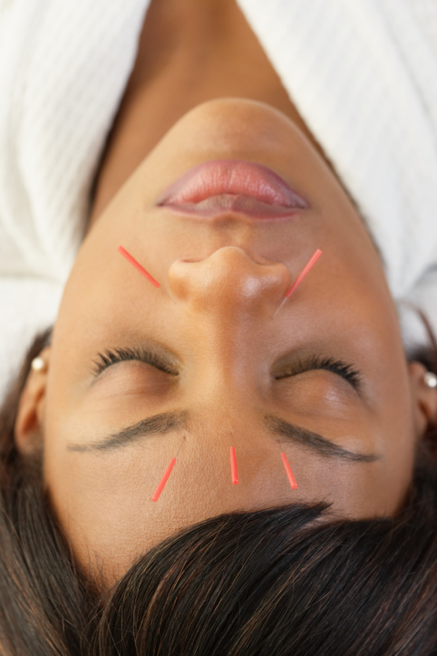 acupuncture
