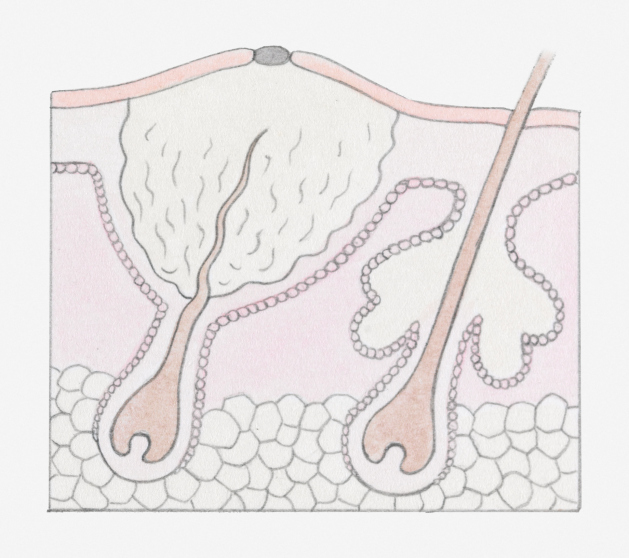 boil under skin
