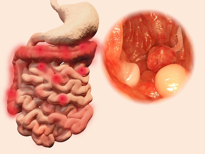 colon cleanse & weight loss