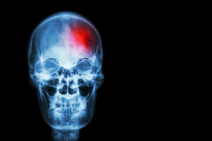 stroke symptoms