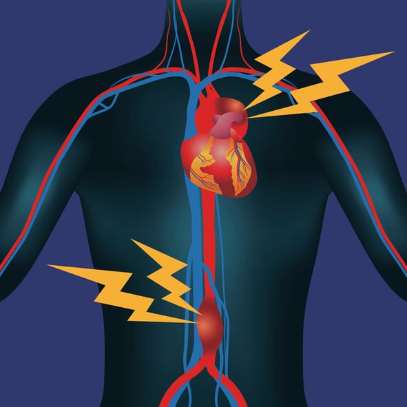 illustrationAbdominal Aortic Aneurysm and Thoracic Aortic Aneurysm