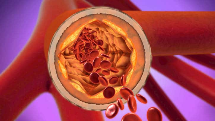 heart vessels or arteriosclerosis