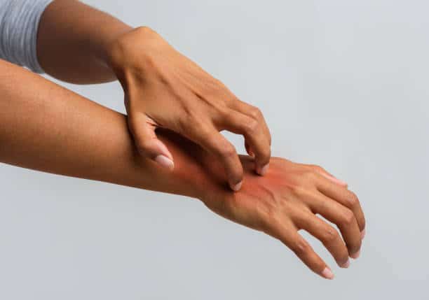 psoriasis