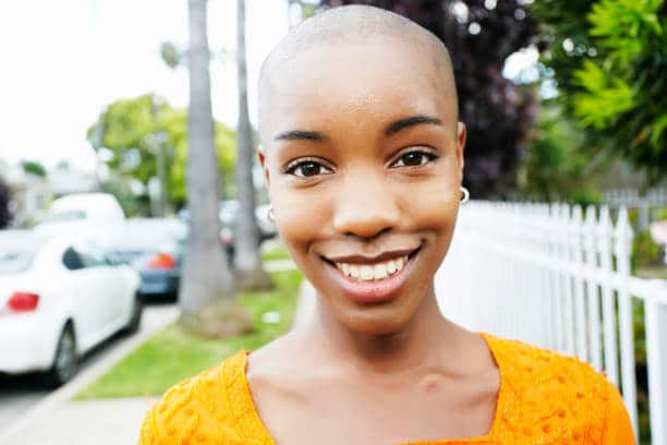 alopecia