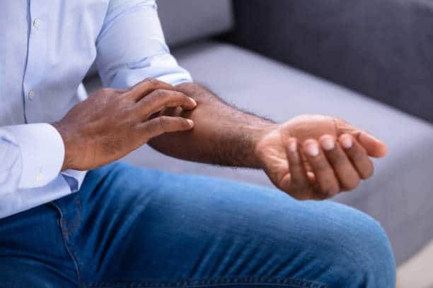 what is scabies