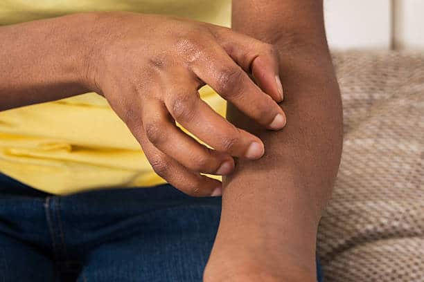 eczema psoriasis