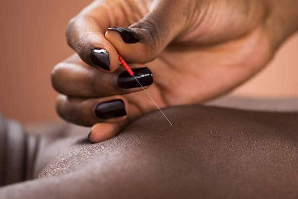 acupuncture