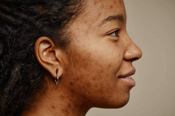 psoriasis scars