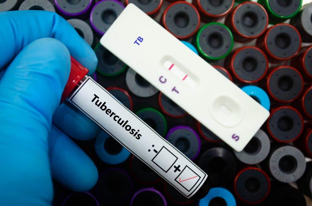 A Black Researcher Is Testing A Late-Stage Tuberculosis Vaccine