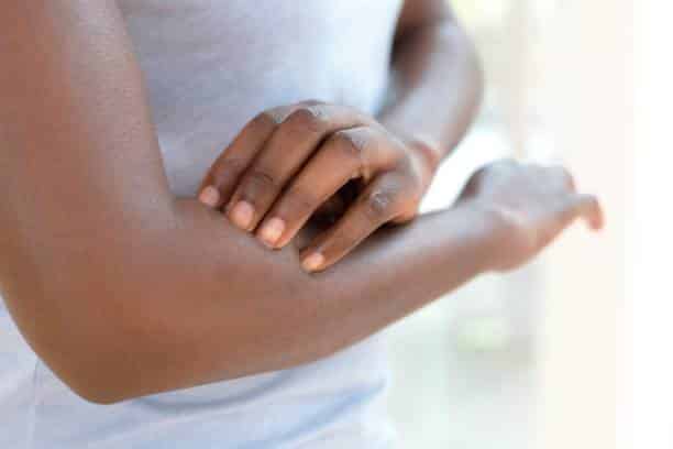 psoriasis treatments