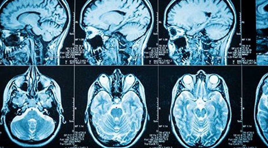 brain tumors