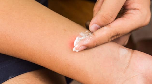 scabies rash