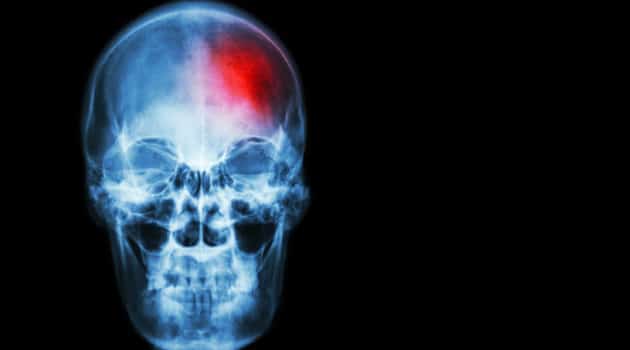stroke symptoms in women