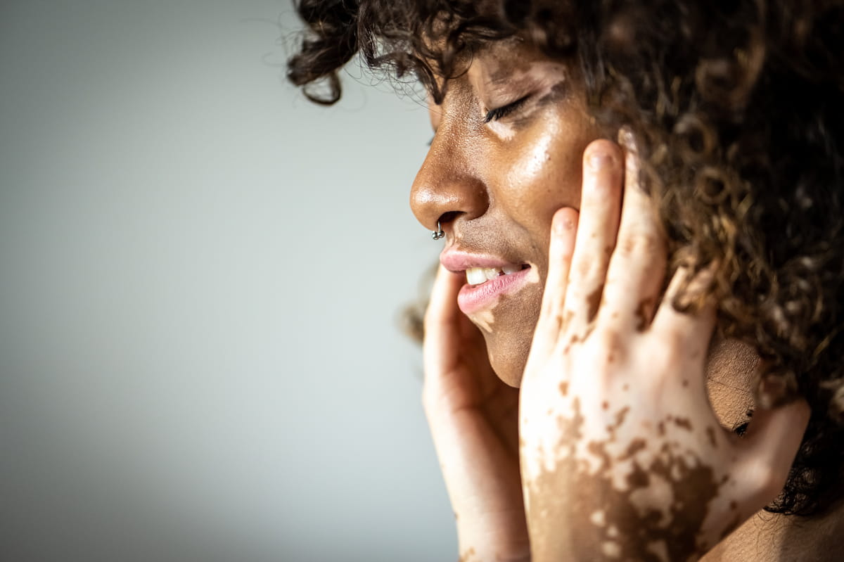 summer style guide, vitiligo